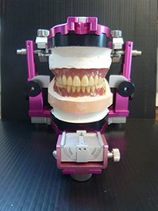 YDL Sapporoで作成した入れ歯